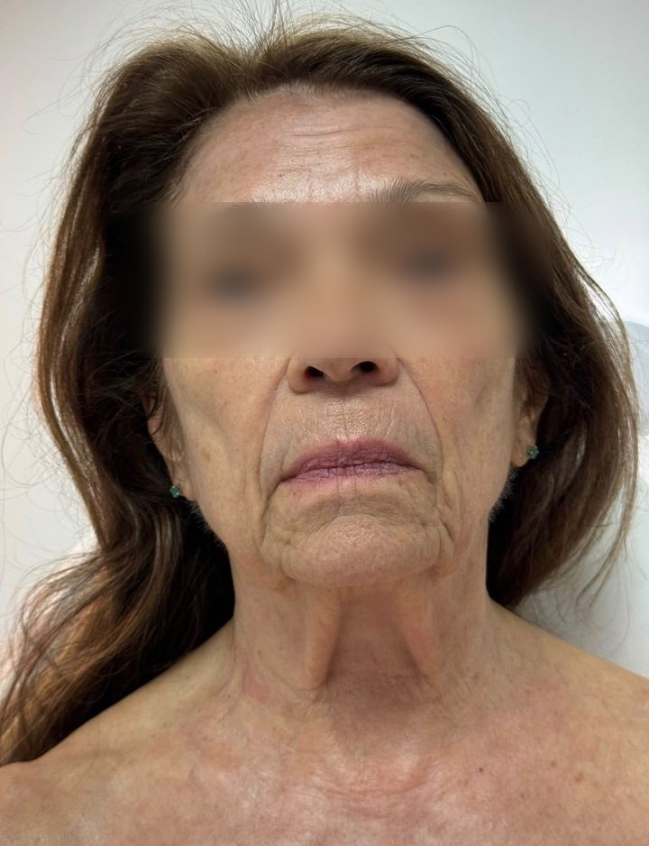 After treatment