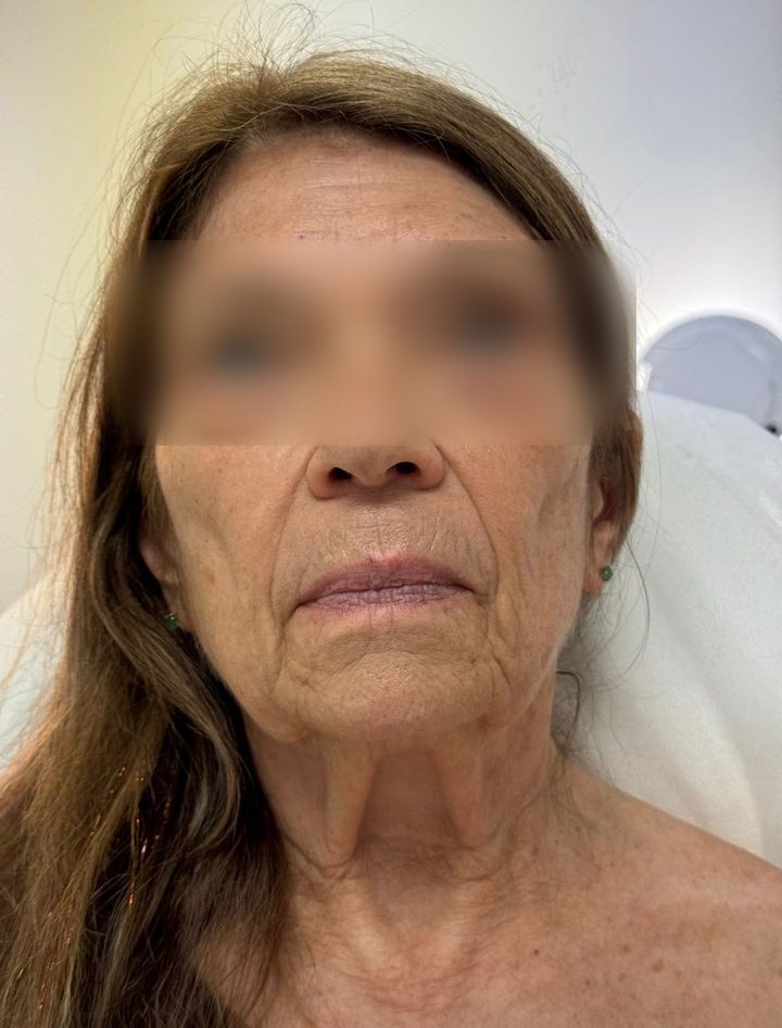 Before treatment