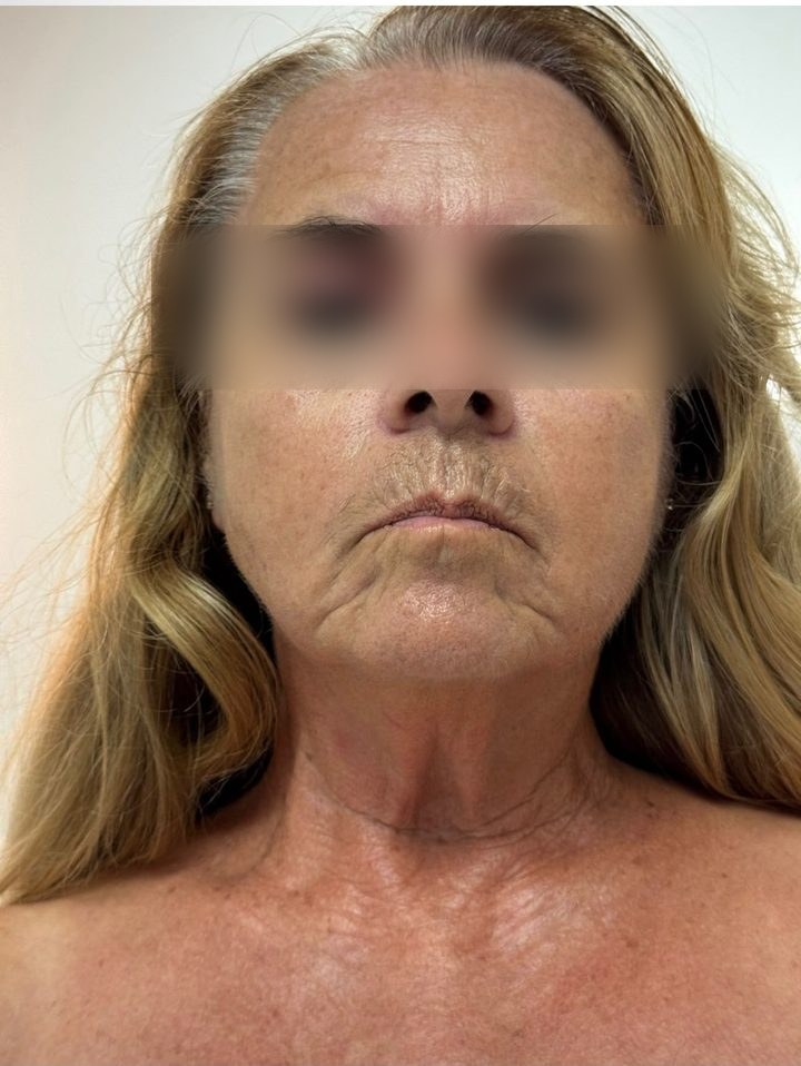 After treatment