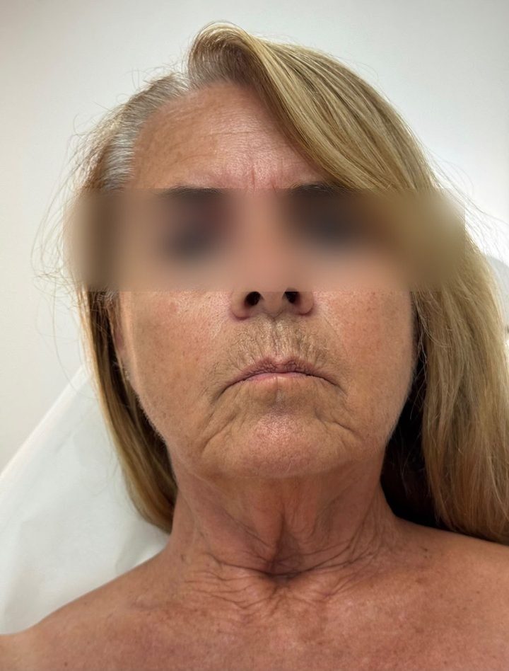 Before treatment