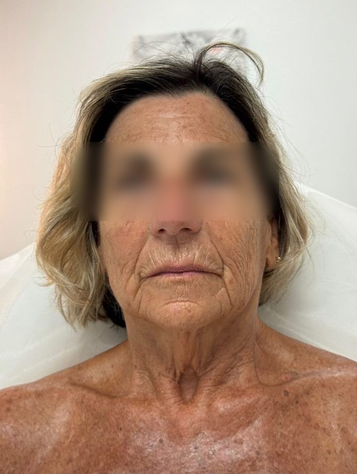 After treatment