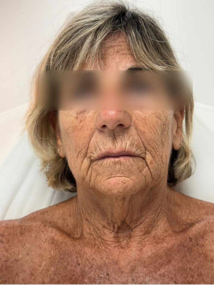 Before treatment